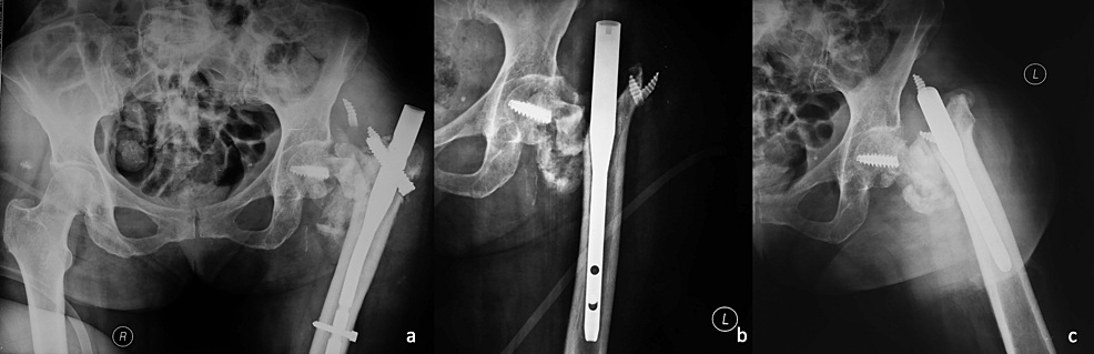 Radiographs showing multifragmented implant and fixation failure in a proximal femoral nail assembly