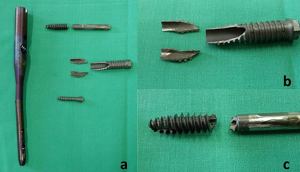 Recovered broken proximal femoral nail implant with broken sleeve and hip screw details