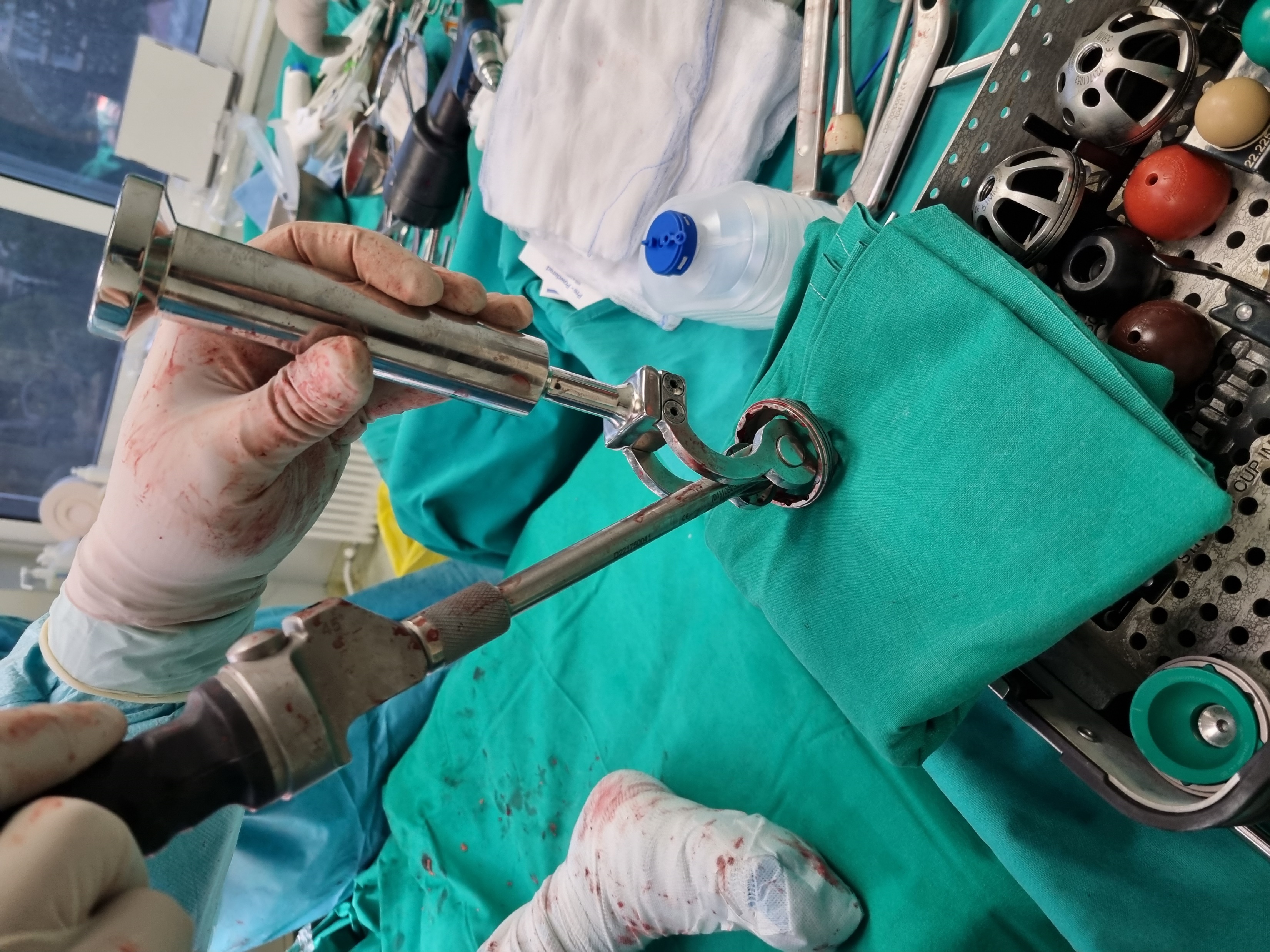 Pilot intraoperative use of the acetabular cup medialization tool