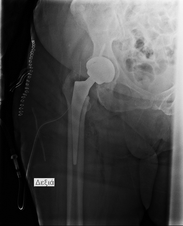 Radiographic example of acetabular cup positioning problems
