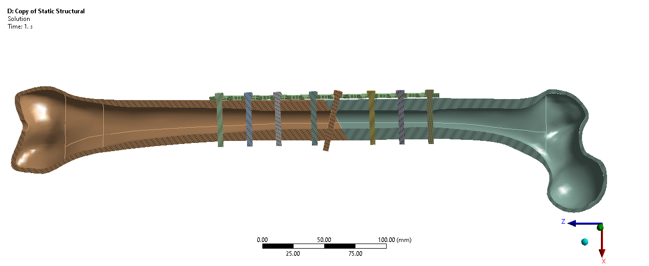 A2 femoral shaft fracture assembly with slot-hole plate and diagonal screw fixation